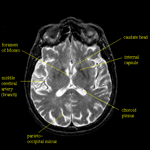 ct brain anatomy
